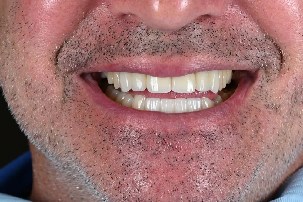 Man smiling with dental veneers
