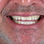 Man smiling with dental veneers