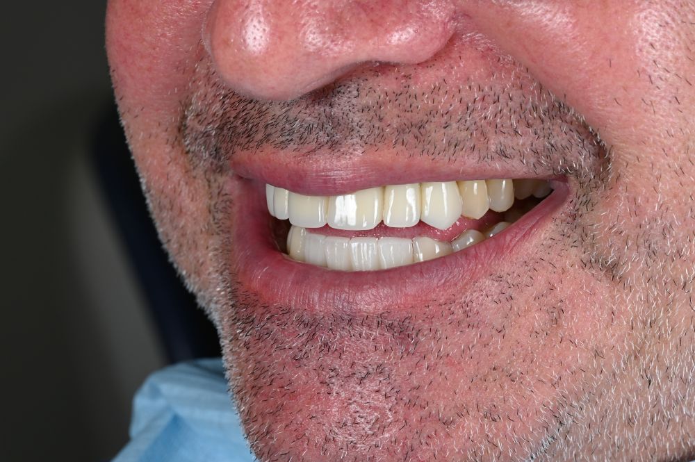 side profile of man smiling with dental veneers
