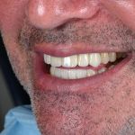 side profile of man smiling with dental veneers