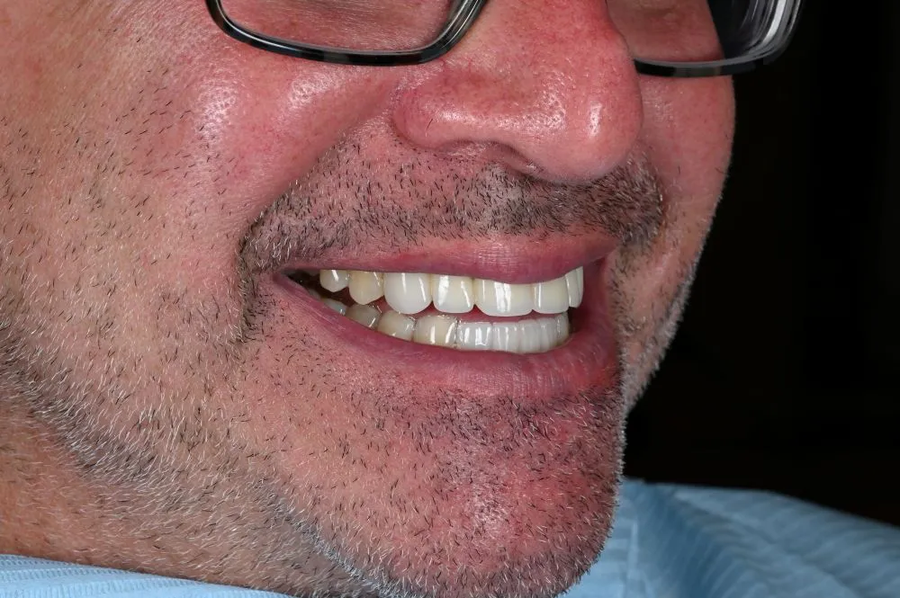 other side profile of man smiling with dental veneers