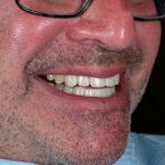 other side profile of man smiling with dental veneers