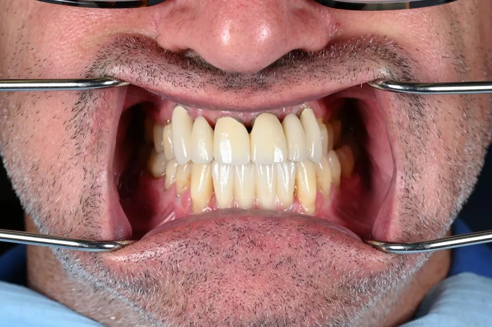 dental veneers procedure with metal clamps