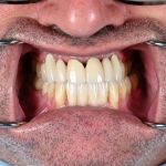dental veneers procedure with metal clamps