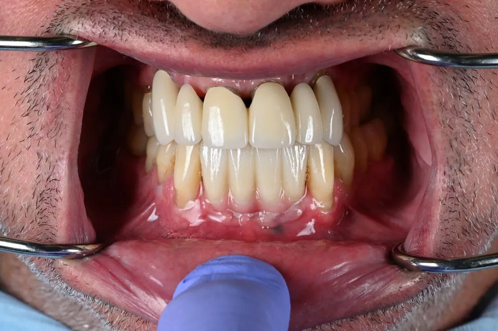 dental veneers procedure with metal clamps front image