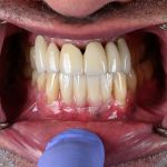 dental veneers procedure with metal clamps front image