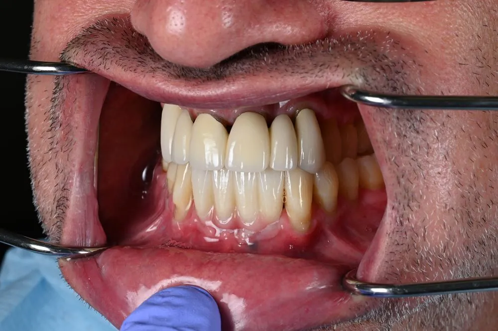 dental veneers procedure with metal clamps side view
