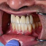 dental veneers procedure with metal clamps side view