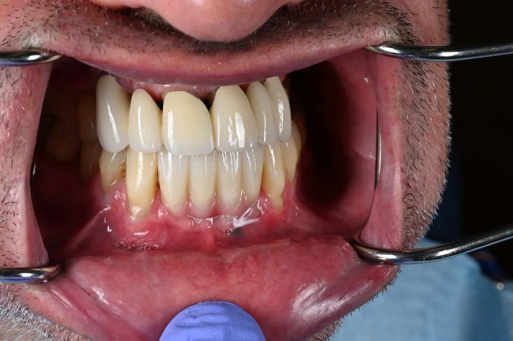 dental veneers procedure with metal clamps up close