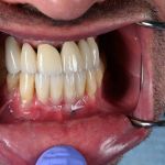 dental veneers procedure with metal clamps up close