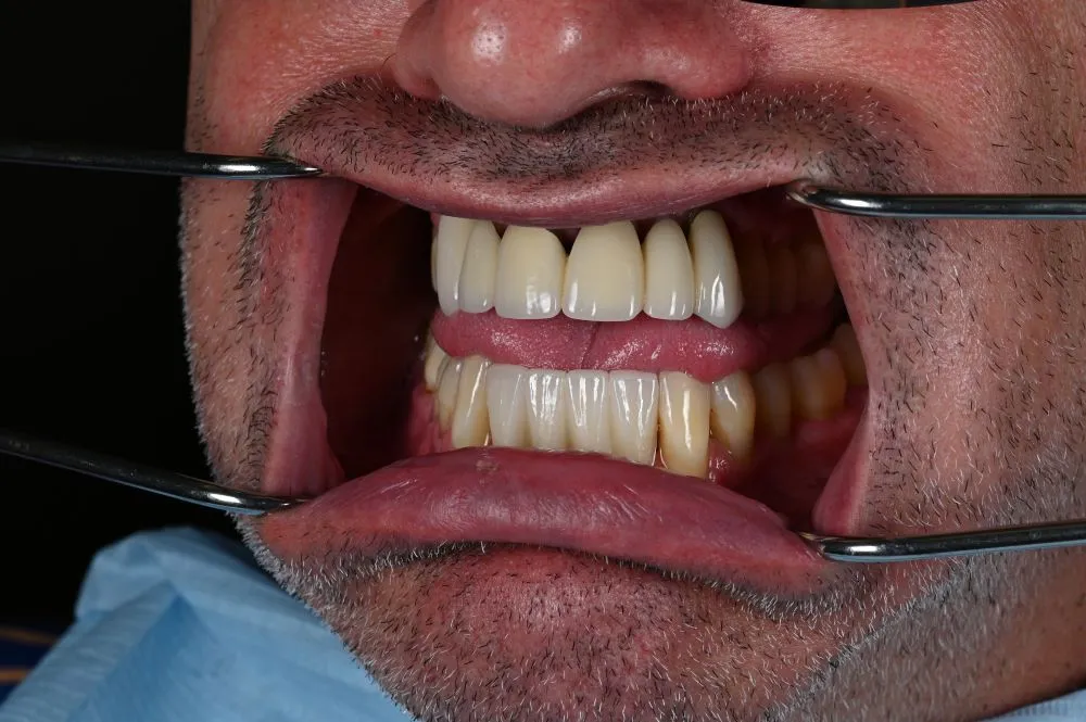 dental veneers procedure with metal clamps other side