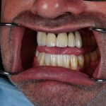 dental veneers procedure with metal clamps other side