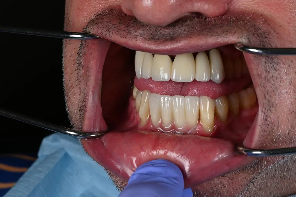 dental veneers procedure with metal clamps 24