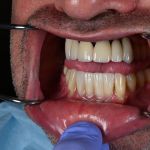 dental veneers procedure with metal clamps 24