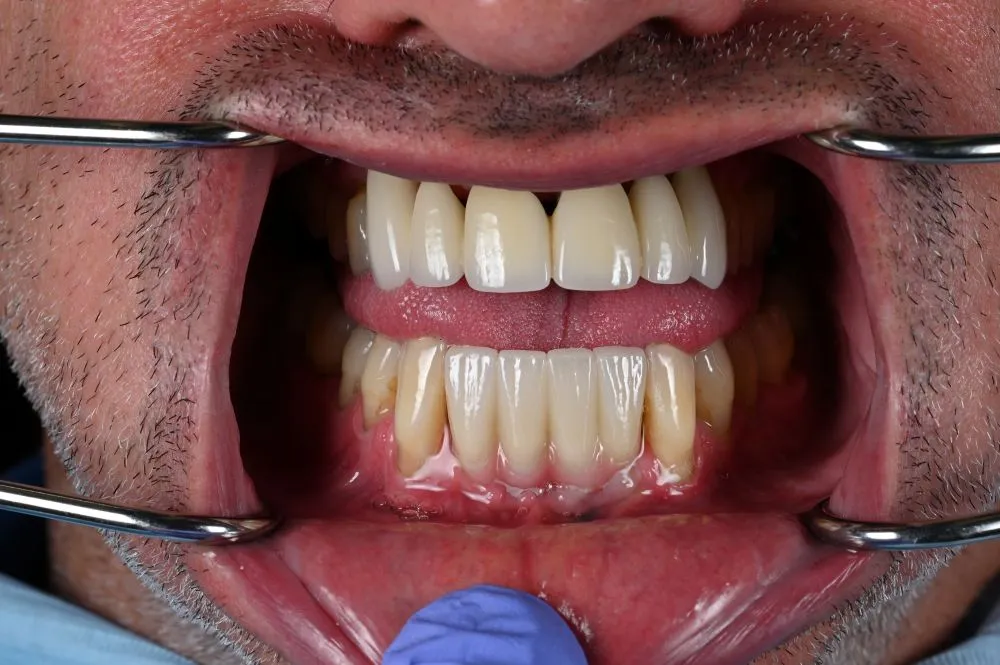 dental veneers procedure with metal clamps 25