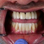 dental veneers procedure with metal clamps 25
