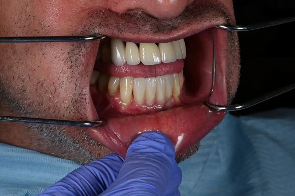 dental veneers procedure with metal clamps 26