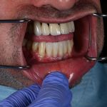 dental veneers procedure with metal clamps 26