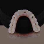 underside of full arch dental implants
