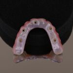 underside of full arch dental implants number 2