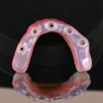 underside of full arch dental implants number 3
