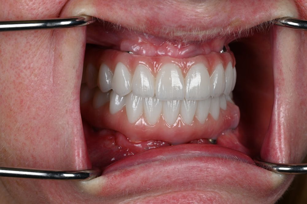 full arch dental implants in a woman's mouth from the side
