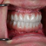 full arch dental implants in a woman's mouth from the side