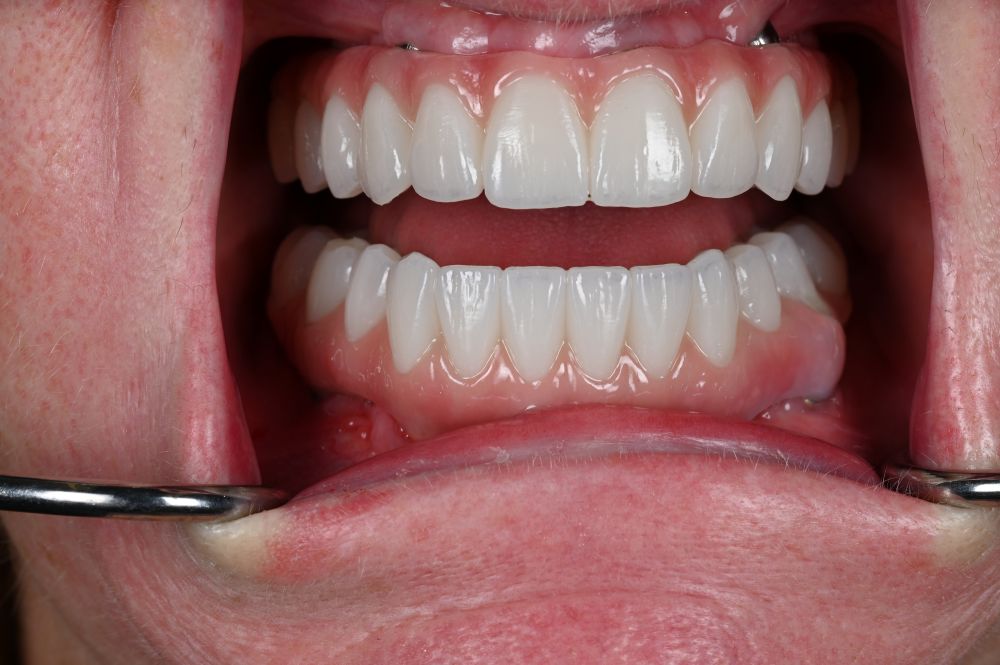 full arch dental implants in a woman's mouth straight on shot