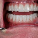 full arch dental implants in a woman's mouth straight on shot