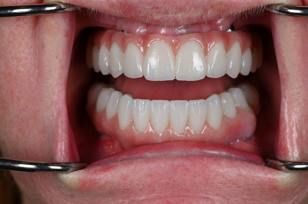 full arch dental implants in a woman's mouth straight on number 2
