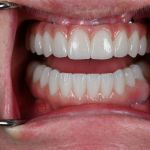 full arch dental implants in a woman's mouth straight on number 2
