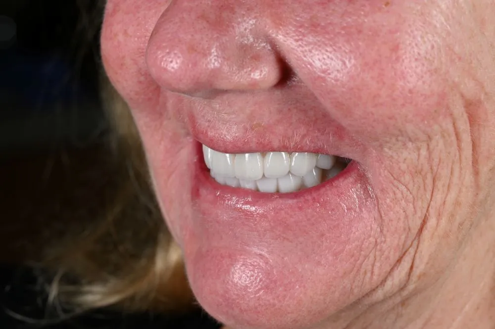 woman smiling with full arch dental implants from the side