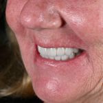 woman smiling with full arch dental implants from the side