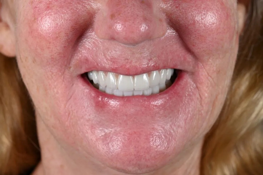 woman smiling with full arch dental implants straight on