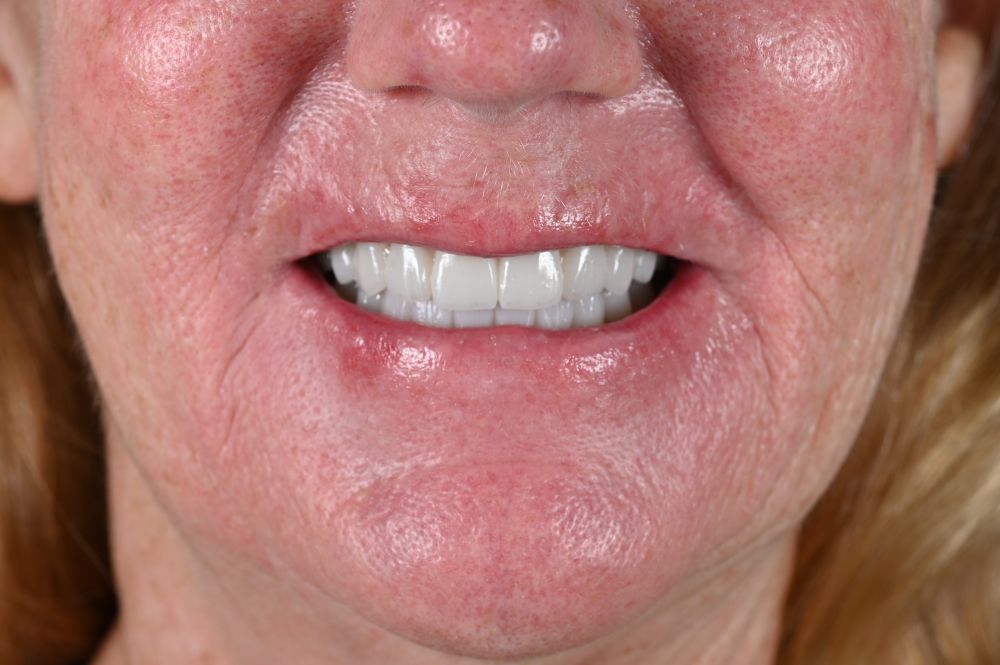 woman smiling with full arch dental implants straight on number 2