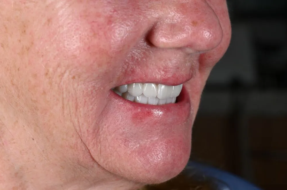 woman smiling with full arch dental implants from left side