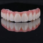 full arch dental implants top teeth straight on