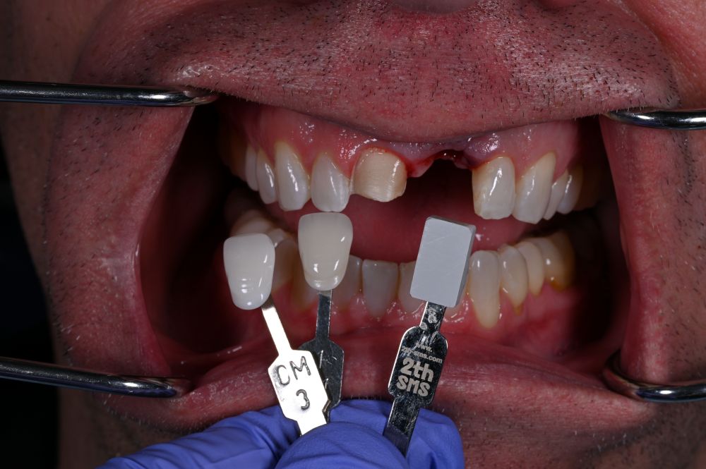 matching the color of the teeth to select the correct shade for dental implant 2