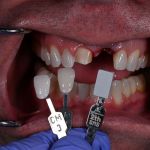 matching the color of the teeth to select the correct shade for dental implant 2
