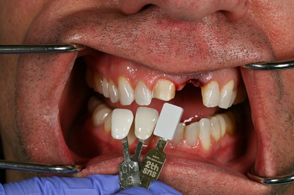 matching the color of the teeth to select the correct shade for dental implant 3