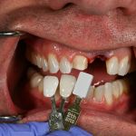matching the color of the teeth to select the correct shade for dental implant 3