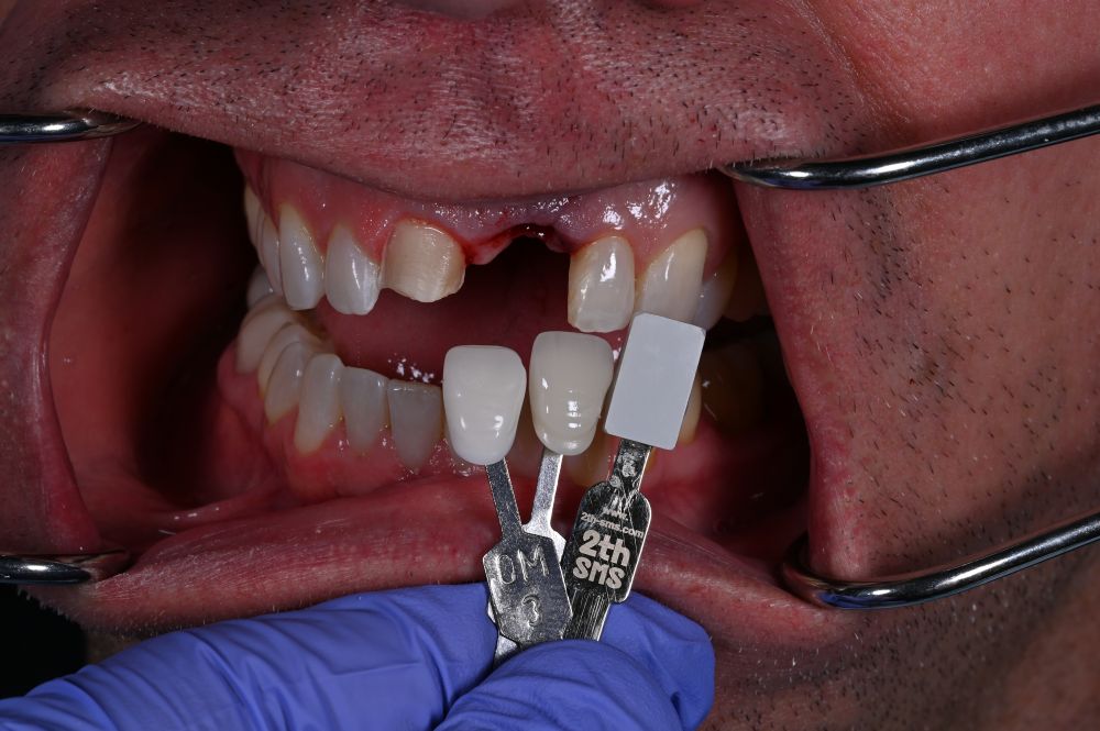 matching the color of the teeth to select the correct shade for dental implant 4