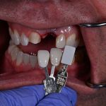 matching the color of the teeth to select the correct shade for dental implant 4