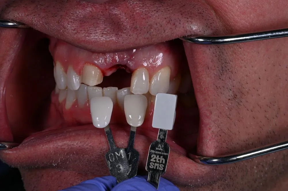 matching the color of the teeth to select the correct shade for dental implant 1