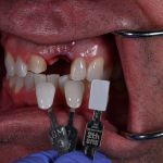 matching the color of the teeth to select the correct shade for dental implant 1
